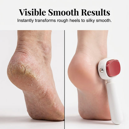 Say Goodbye to Rough, Cracked Heels — Reveal Softer, Smoother Feet in Minutes